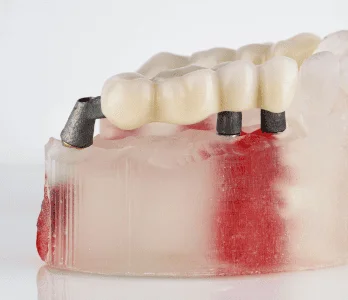 Dental crowns and bridges restoration in Patna