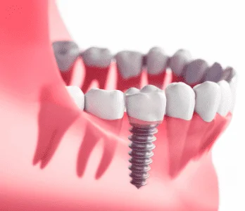 Dental implants procedure at Dental Comfort Zone, Patna
