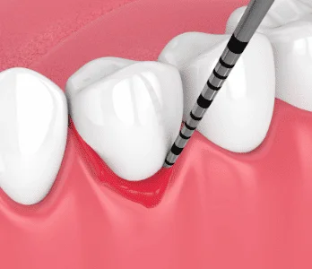 Gum disease treatment and periodontal care in Patna