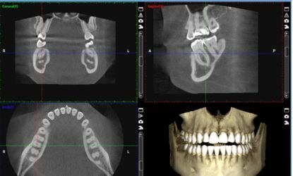 Three-dimensional CBCT reconstruction of the jawbone