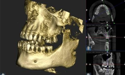 Cross-sectional CBCT scan for dental implant assessment