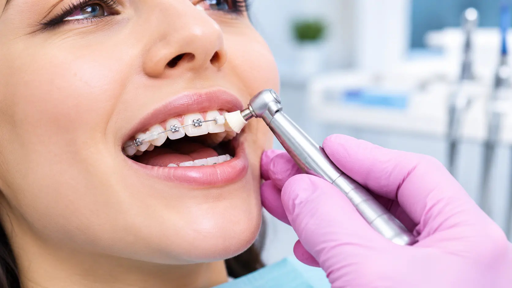Deep Cleaning in Patna | Scaling and Polishing