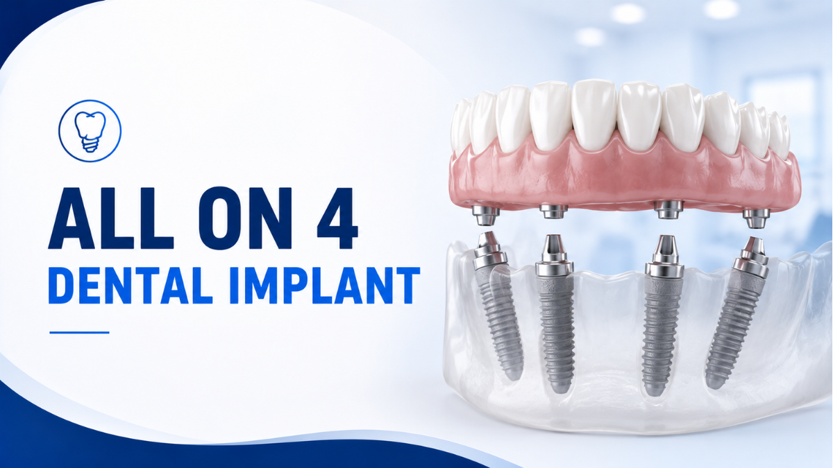 All on 4 dental implant
