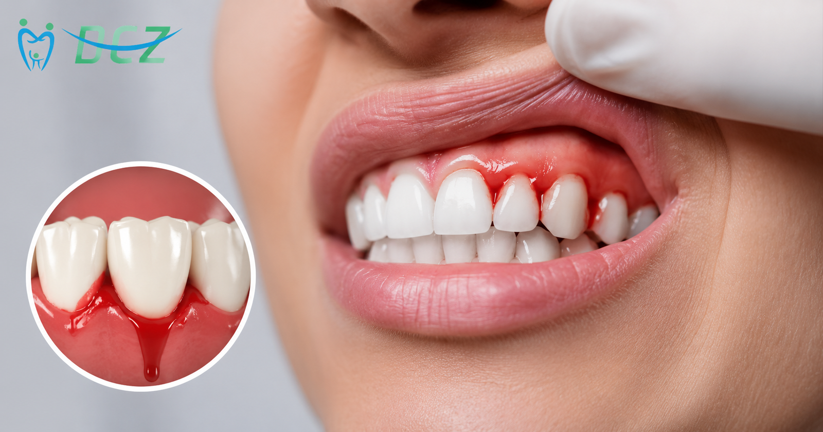 Why Bleeding Gums Happen, How to Treat Them &amp;amp; Ways to Prevent Them