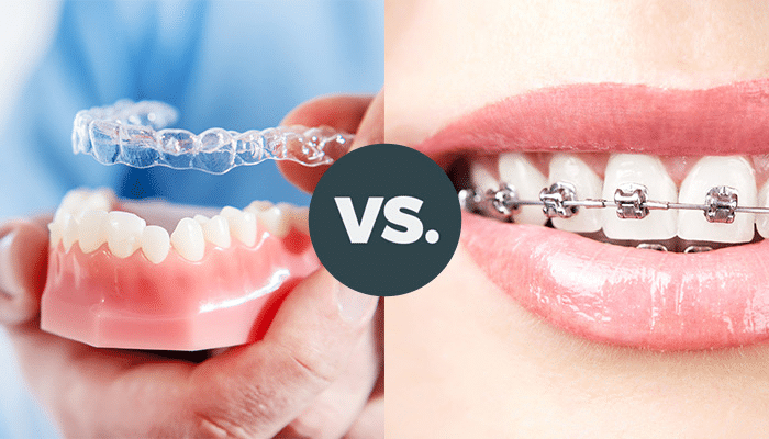Orthodontist placing braces or fitting clear aligners during orthodontic treatment in Patna