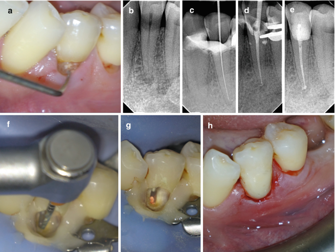 Dentist shaping root canal during root canal treatment procedure in Patna