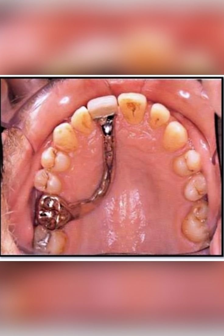 Cantilever dental bridge supported by a single adjacent tooth