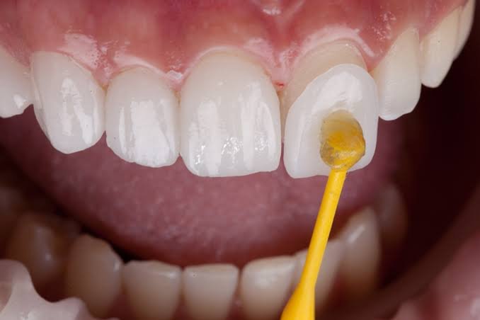 Ceramic veneers treatment to improve the appearance of teeth in Patna