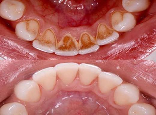Child receiving professional teeth cleaning treatment at a pediatric dental clinic in Patna