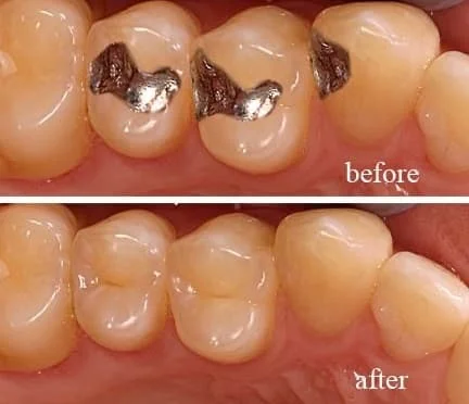 Dentist performing a tooth-colored filling for a child in Patna