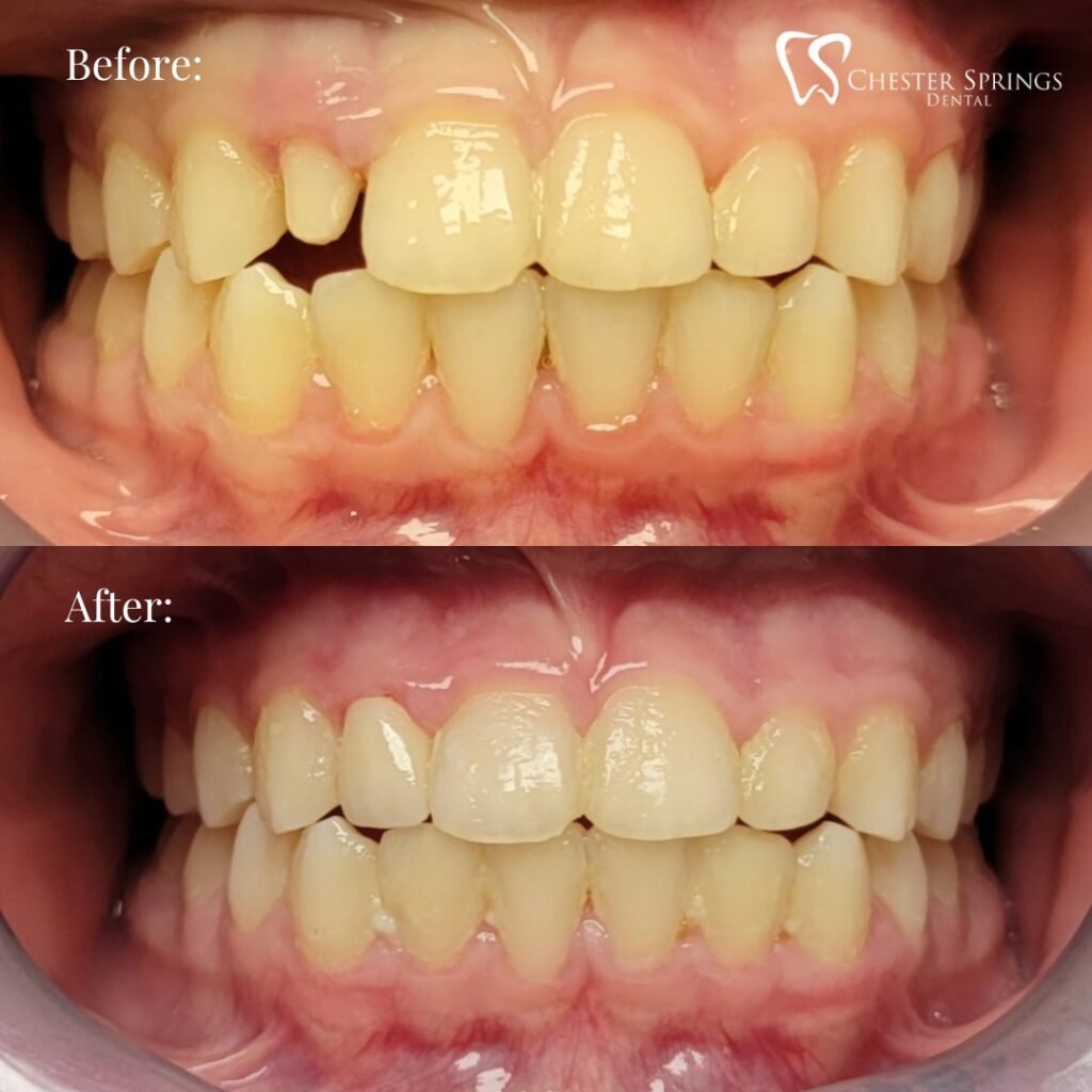 Dentist placing a dental crown after root canal treatment in Patna