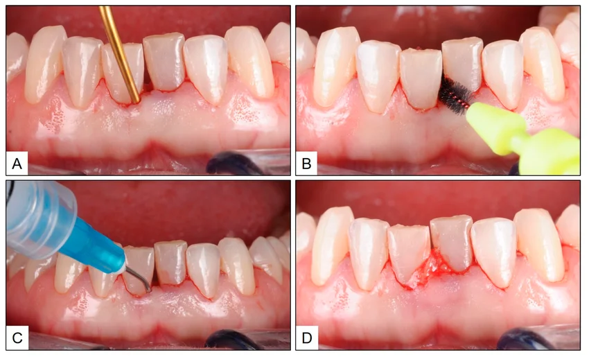 Dentist performing deep cleaning below the gumline to treat gum inflammation