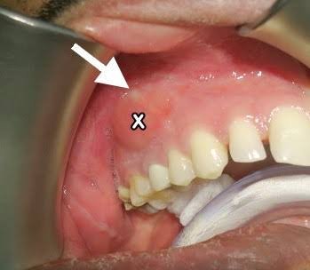 Dental abscess drainage procedure for infection and swelling relief in Patna