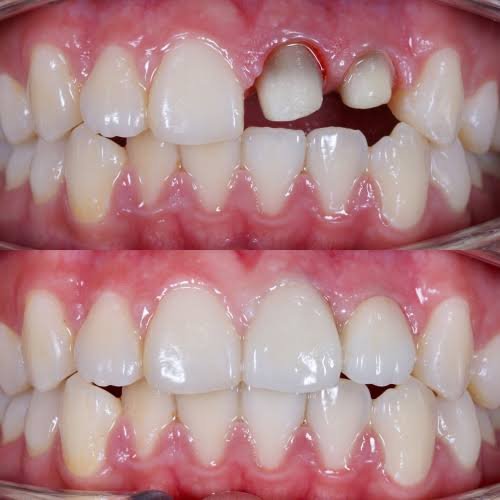 Dental crown placement to restore weakened tooth in Patna
