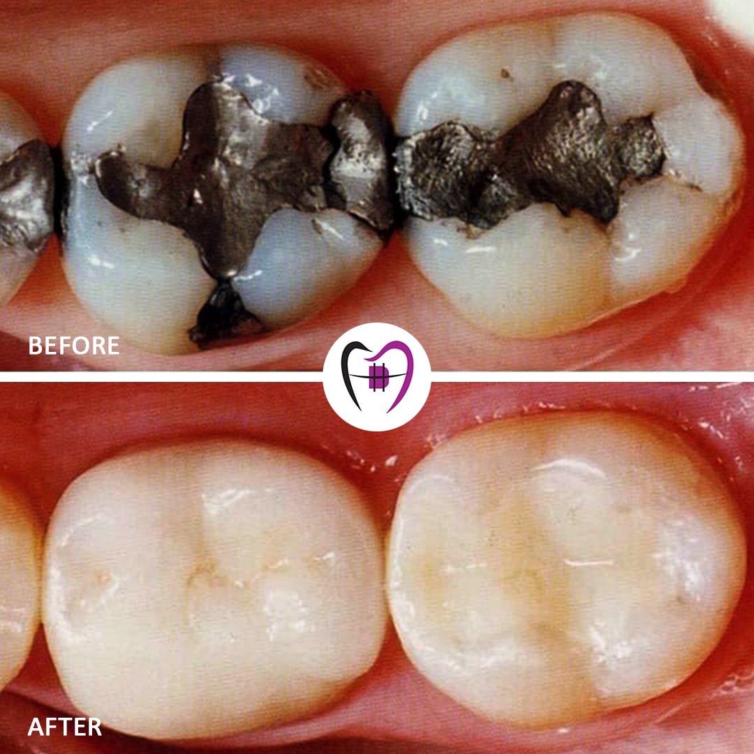 Dentist performing tooth-colored dental filling treatment for cavity in Patna