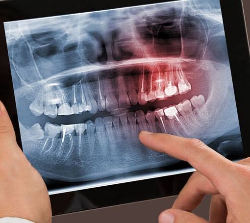 Digital dental X-ray used to examine tooth roots during root canal treatment in Patna