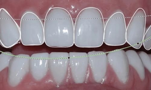 Dentist using digital technology to plan a patient’s cosmetic smile treatment in Patna.