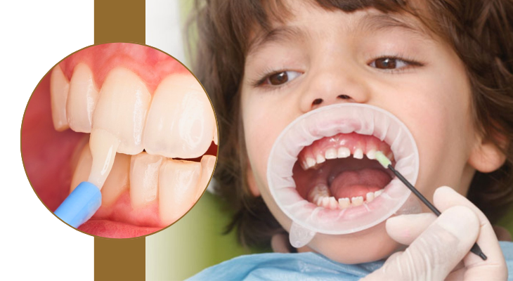 Dentist applying fluoride treatment to strengthen a child's teeth in Patna