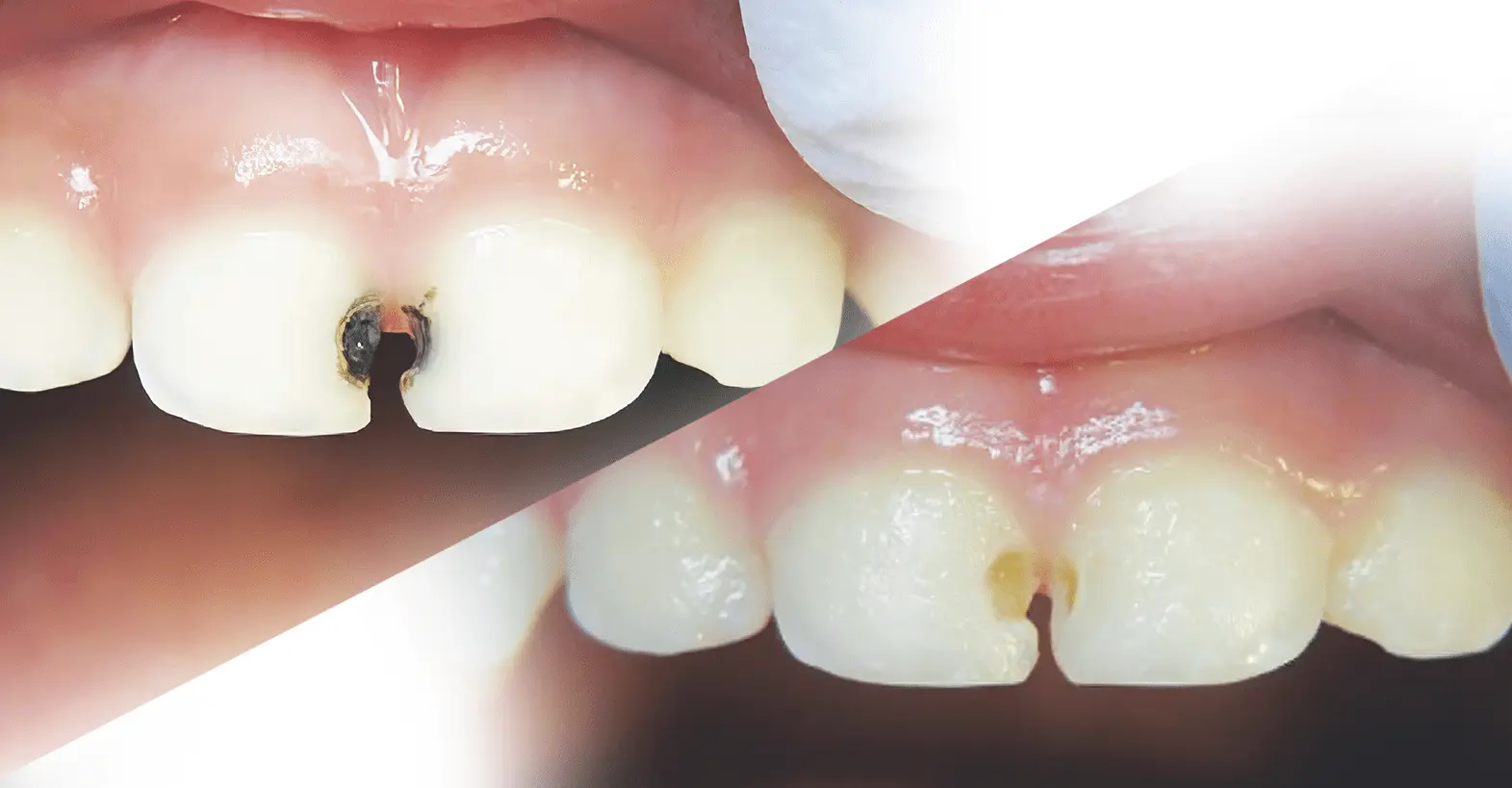 Fluoride treatment applied to strengthen enamel and reduce tooth sensitivity