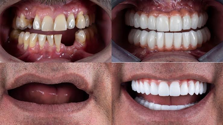 Full mouth dental implants restoring missing teeth and improving oral function in Patna