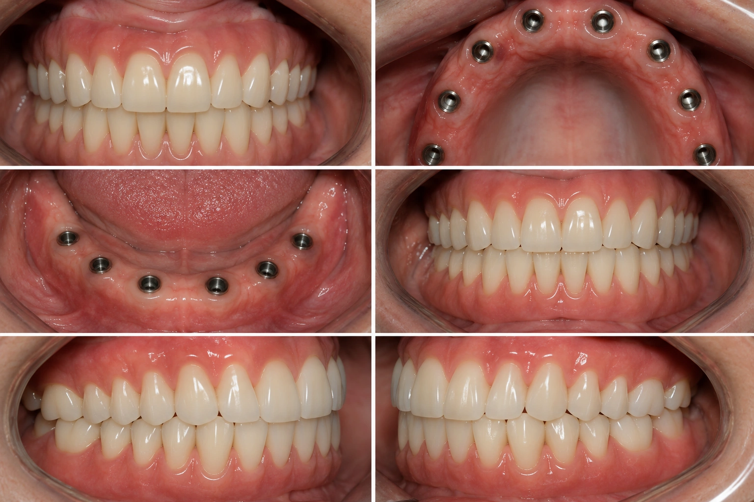 Full mouth dental implants smile.