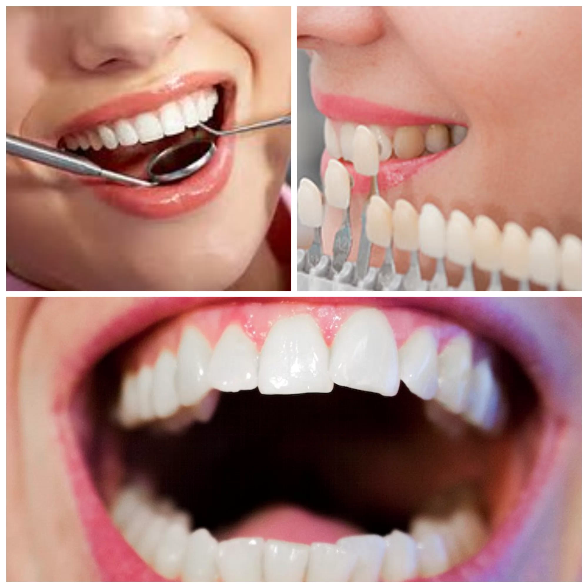 Full mouth smile makeover to improve the appearance and harmony of the smile in Patna