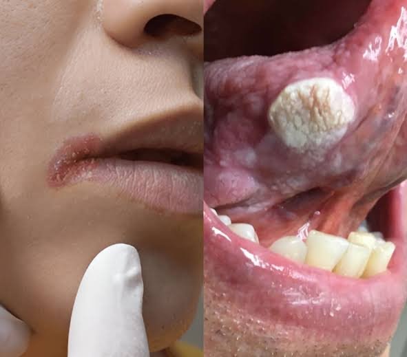 Dentist checking gums for early signs of gum cancer in Patna