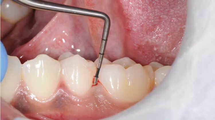 Dentist examining a patient’s gums with a periodontal probe during a professional dental examination.