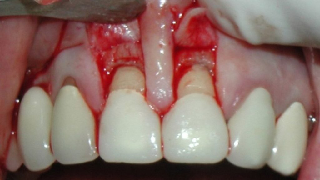 Dentist performing gum flap surgery to treat advanced periodontal disease in Patna