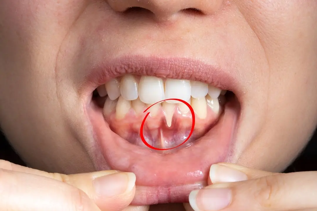 Gum grafting treatment for receding gums and exposed tooth roots in Patna