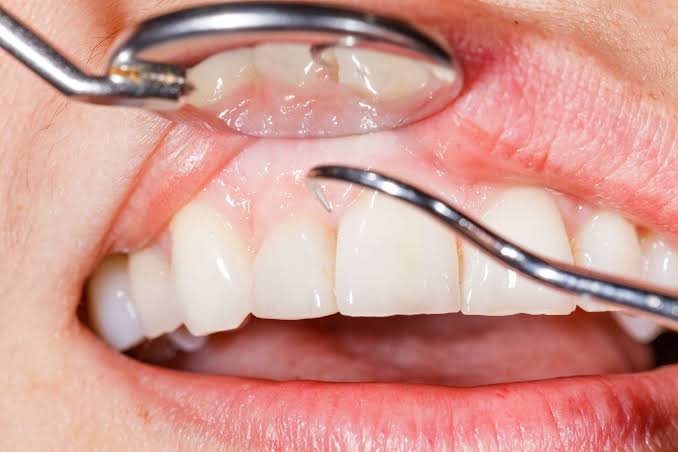 Gum treatment for infection-related toothache at dental clinic in Patna