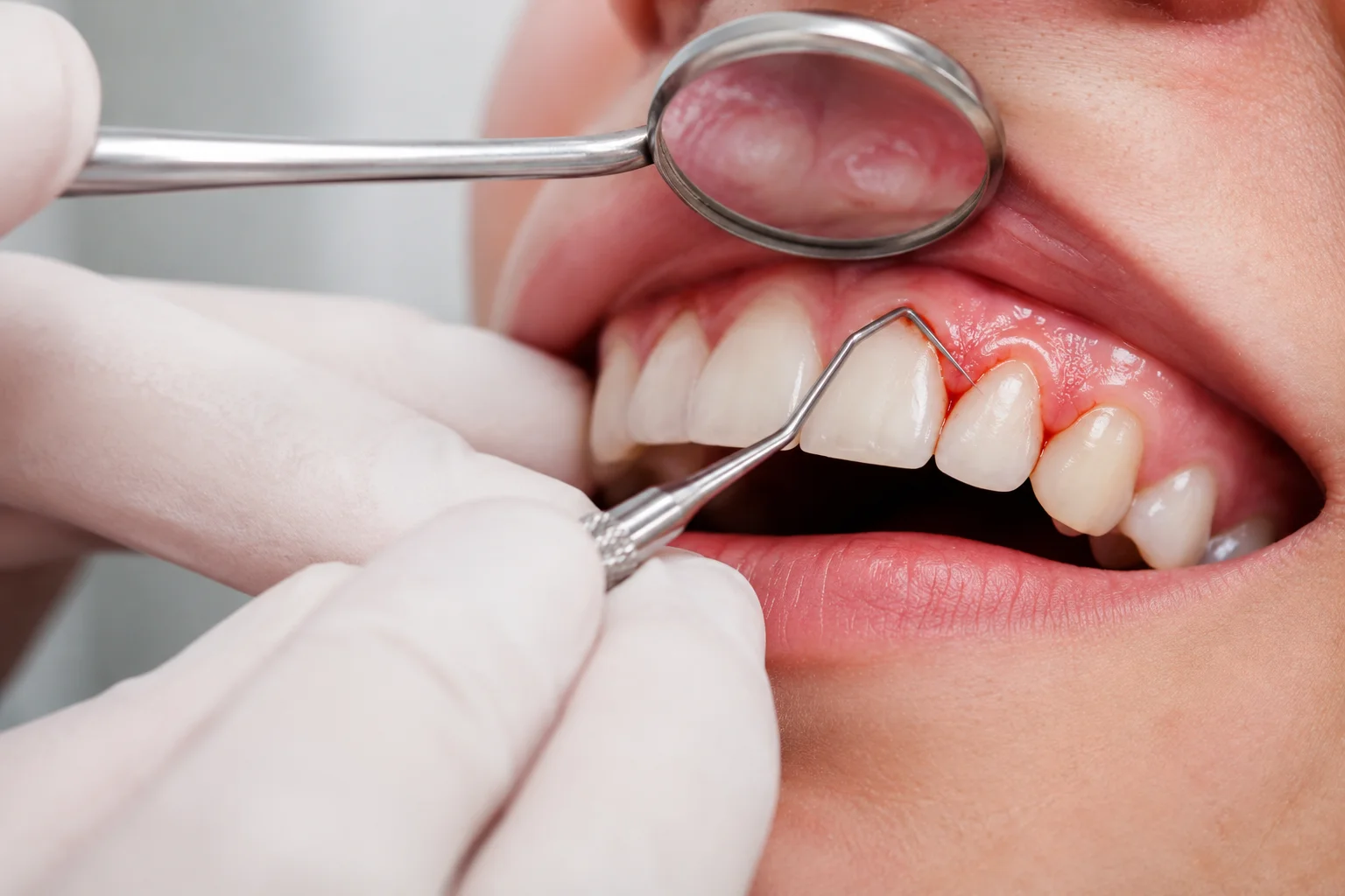 Bleeding Gums: Causes, Treatment &amp;amp;amp; Prevention