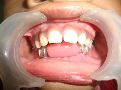 Pediatric dentist guiding habit correction treatment for a child in Patna