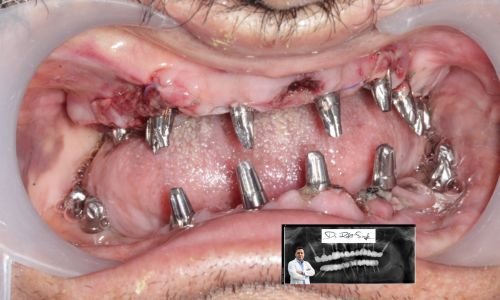 Immediate and same-day dental implant procedure illustration.