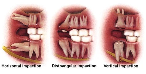 Impacted tooth extraction in Patna