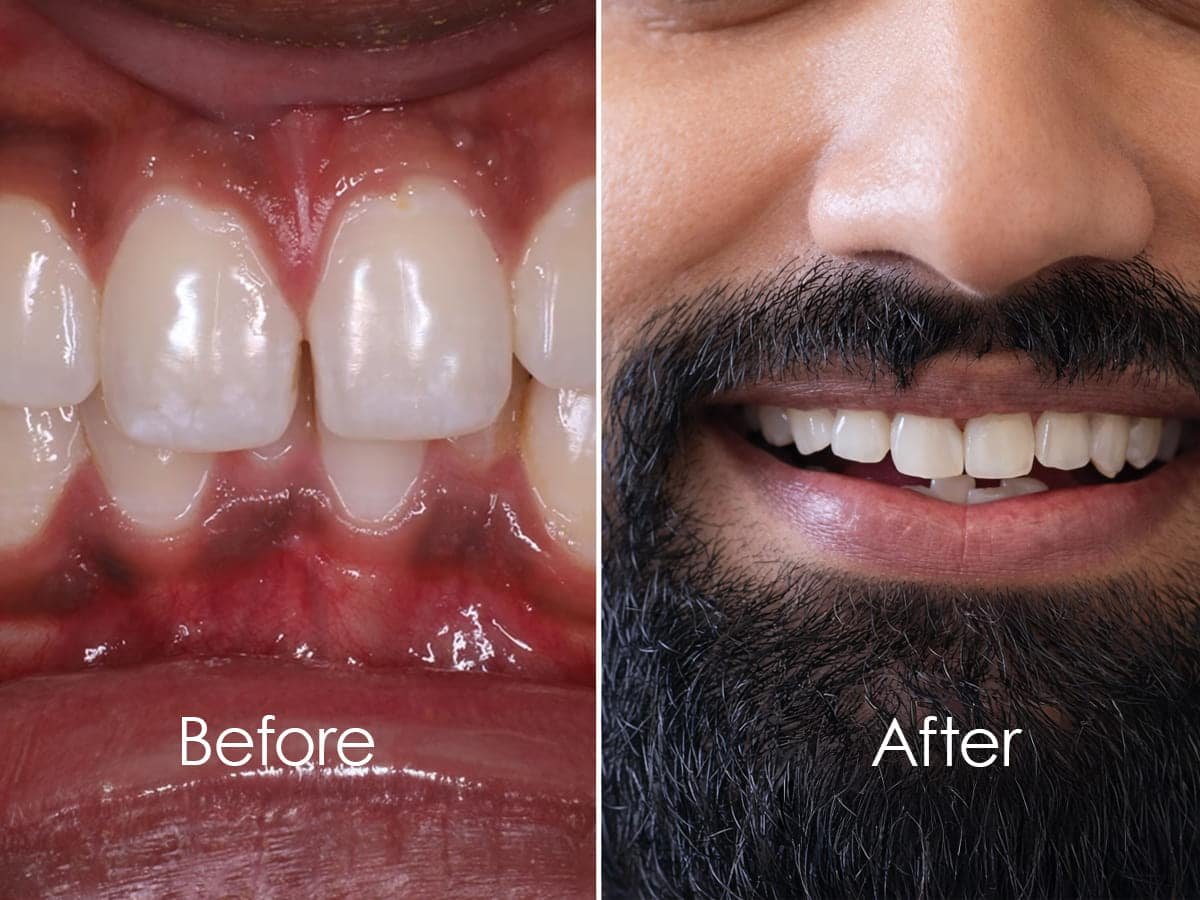 Dental implant healing and bonding with jawbone during osseointegration in Patna