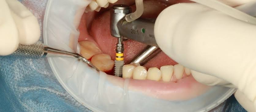 Dentist performing dental implant placement surgery under local anaesthesia in Patna