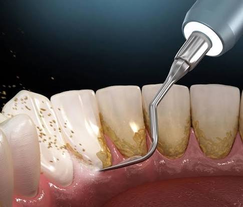 Laser gum treatment for treating gum disease and improving gum health in Patna