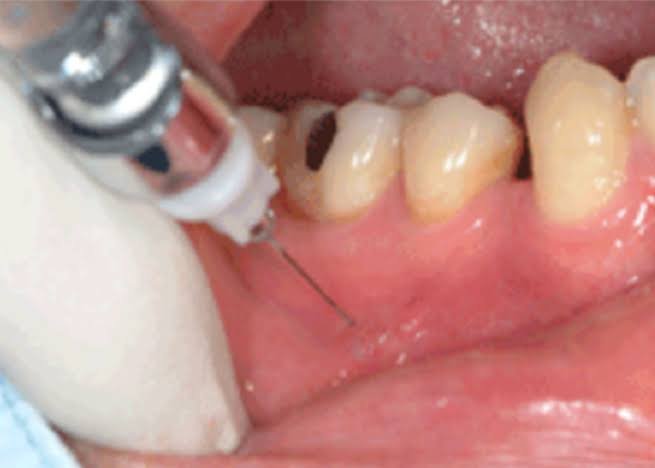 Dentist administering local anaesthesia before root canal treatment in Patna