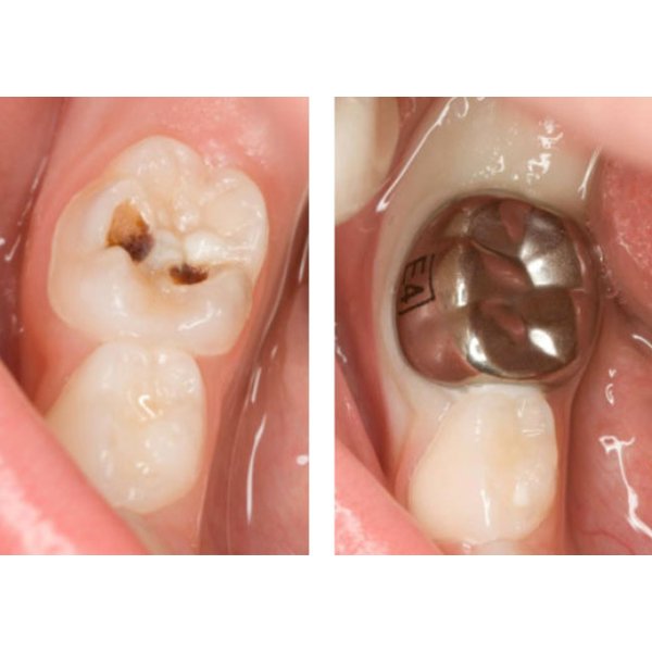 Metal dental crown used to restore a damaged back tooth in Patna