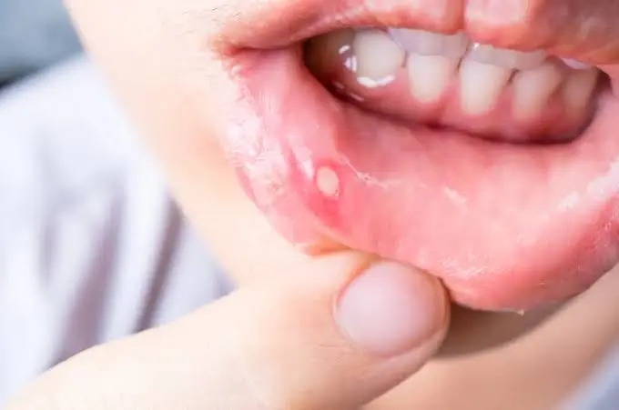Close-up of a painful mouth ulcer on the inner lower lip before treatment in Patna