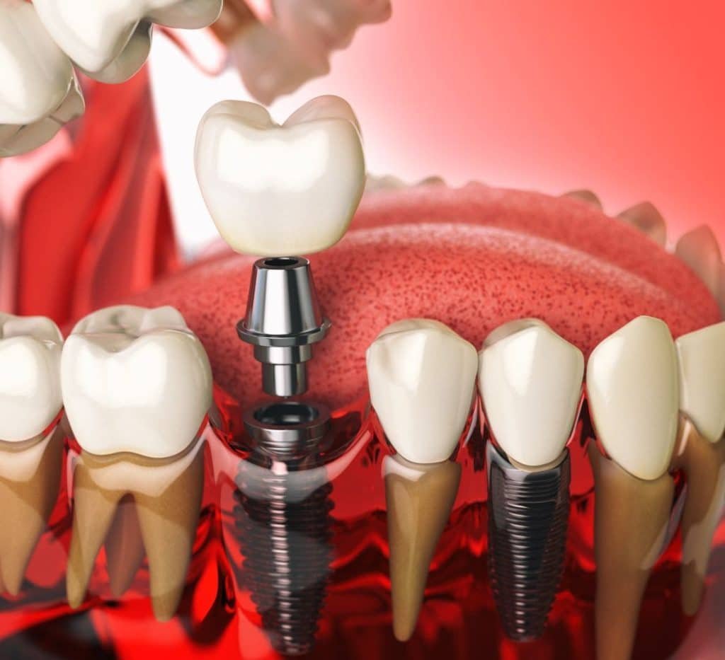 Multiple dental implants replacing several missing teeth in Patna