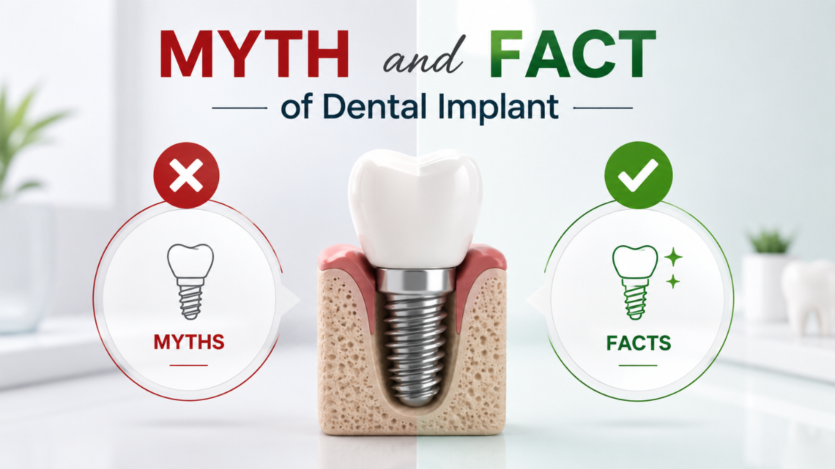 Myth and Fact of Dental Implant: What Every Patient Should Know Before Choosing Dental Implant