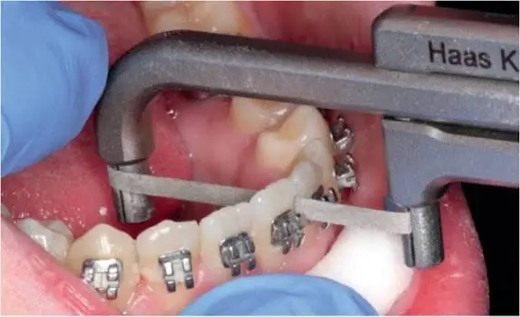 Tooth extraction for orthodontic treatment