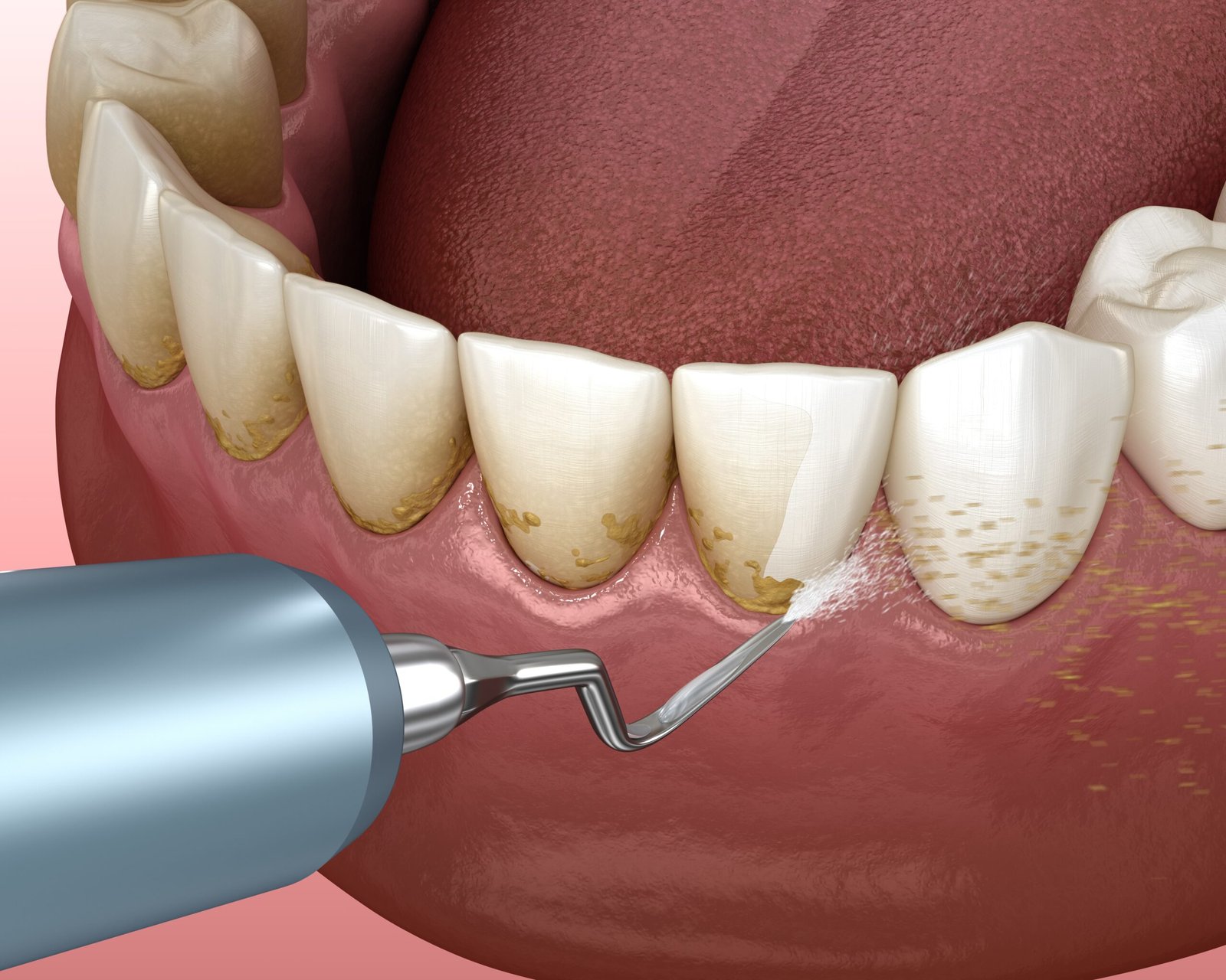 Professional dental cleaning procedure removing plaque and tartar buildup from teeth and along the gumline.