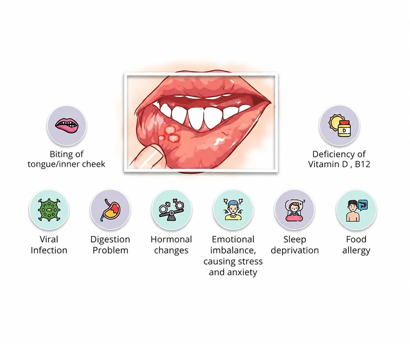 Recurring mouth ulcer management