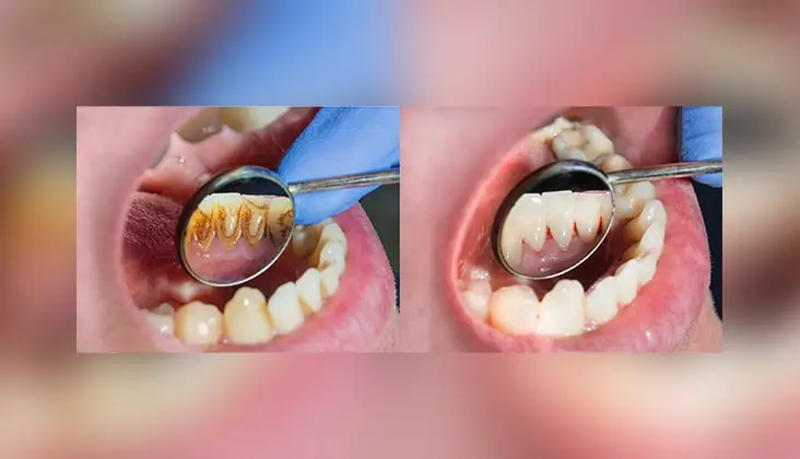 Dental professional performing regular teeth cleaning to remove surface plaque in Patna