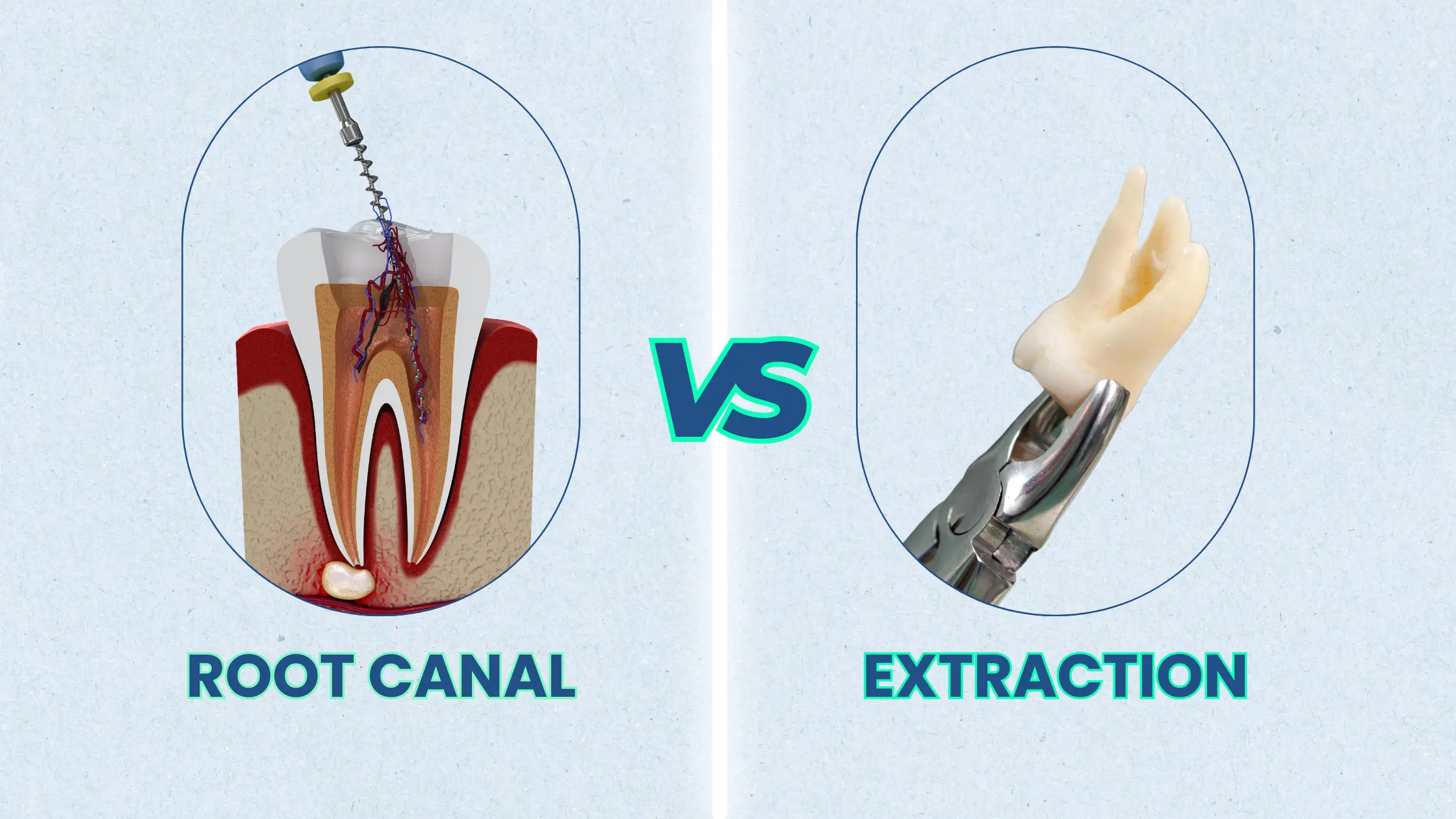 Root extraction procedure in Patna