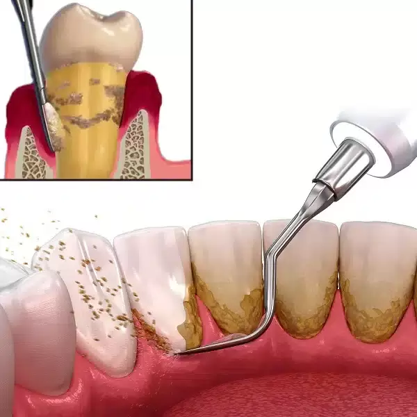 Scaling and root planing procedure removing plaque and tartar buildup from the teeth and below the gumline.