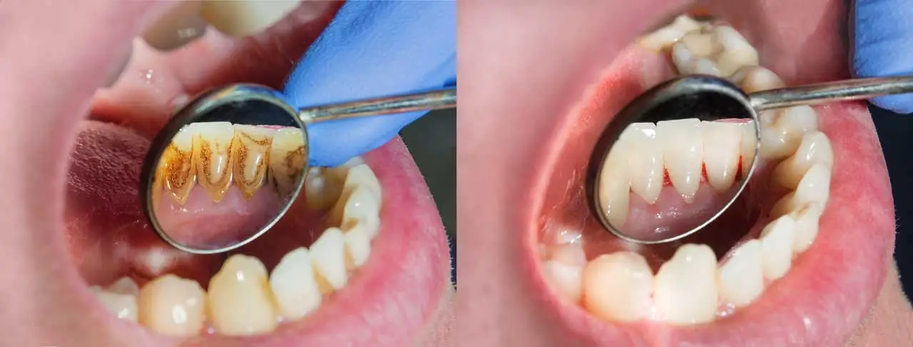 Dental scaling procedure removing plaque and tartar from teeth in Patna